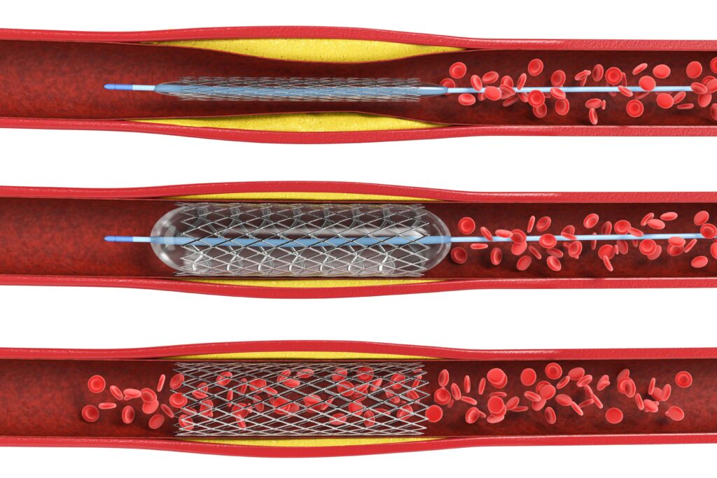 3d rendering balloon angioplasty procedure with stent in vein isolated on white